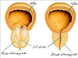 پروستات، آنچه هر مردی باید بداند